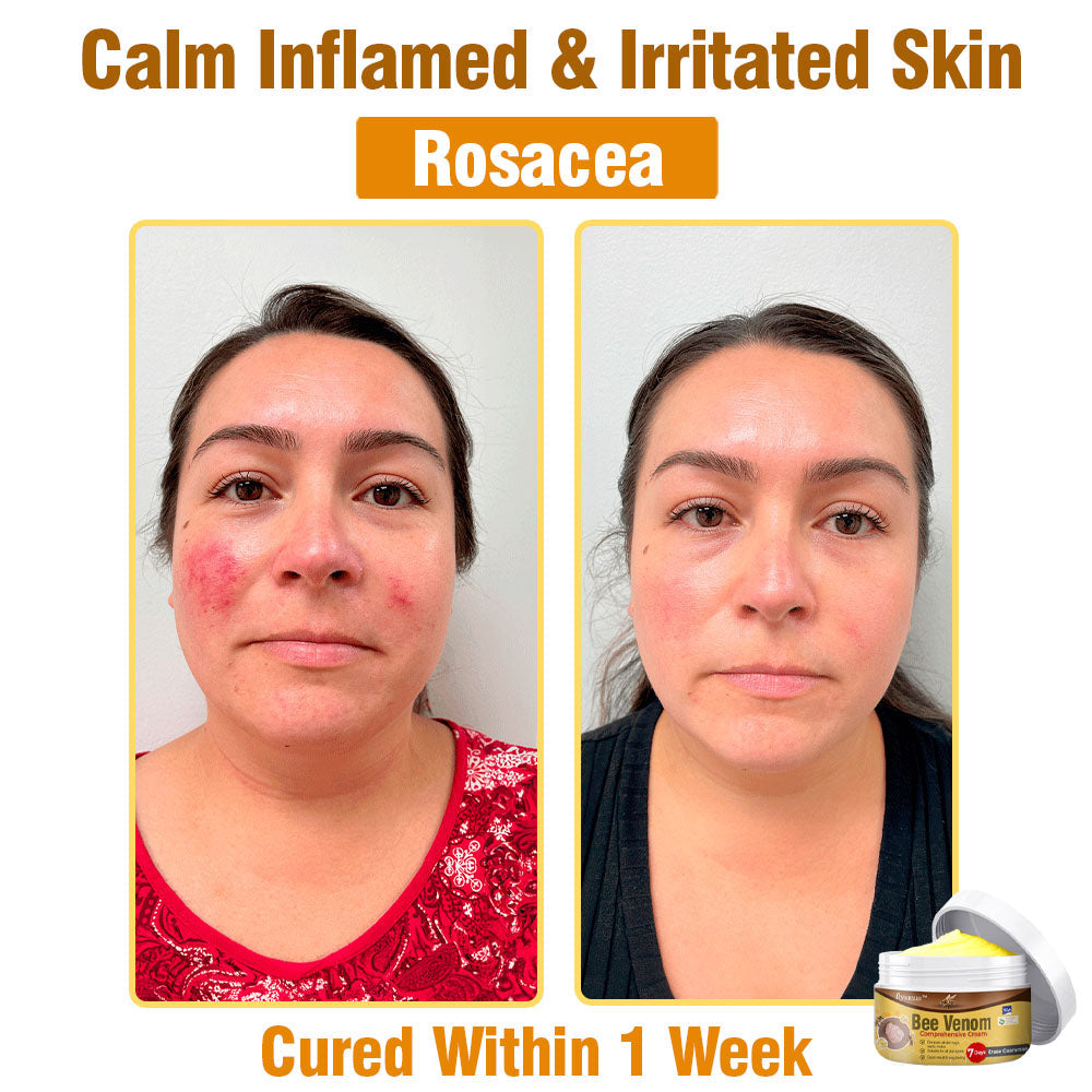 ⛑️🇦🇺 flysmus™ Bee Venom Comprehensive Skin Treatment Cream 🇦🇺 Dermatologist Approved