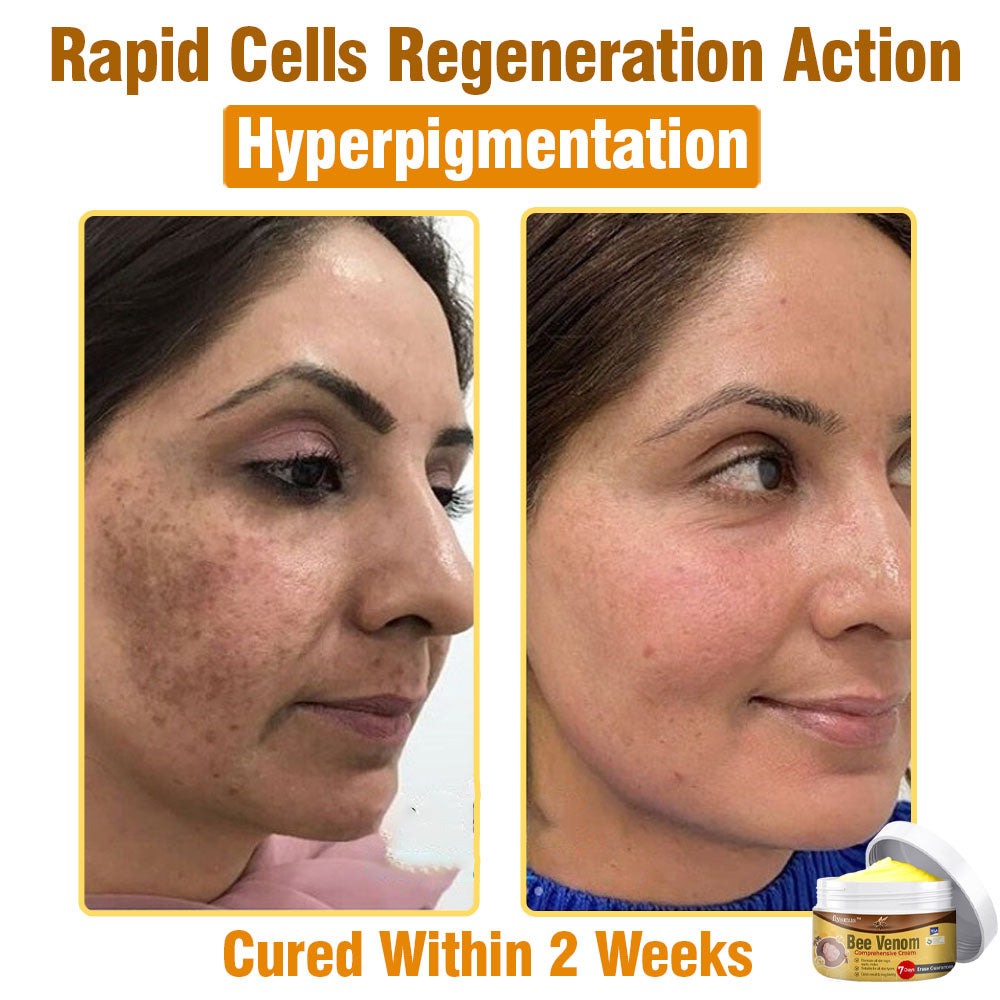 ⛑️🇦🇺 flysmus™ Bee Venom Comprehensive Skin Treatment Cream 🇦🇺 Dermatologist Approved