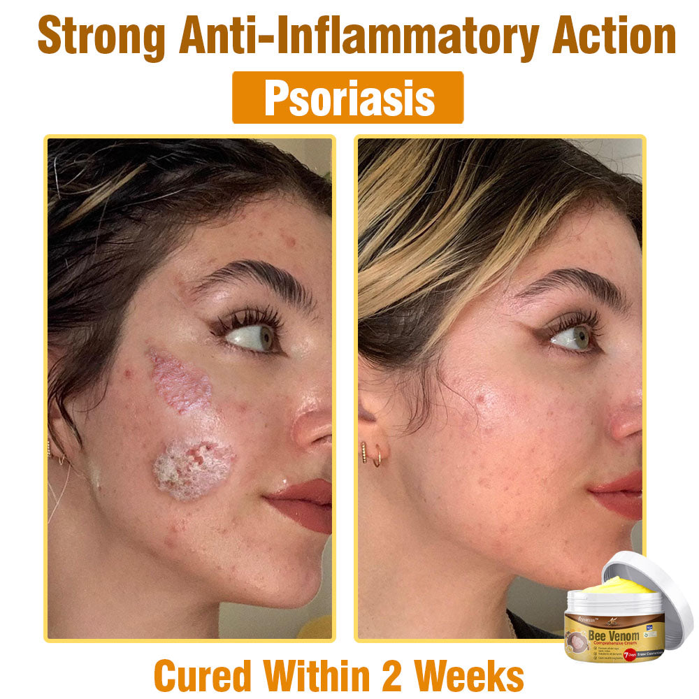 ⛑️🇦🇺 flysmus™ Bee Venom Comprehensive Skin Treatment Cream 🇦🇺 Dermatologist Approved