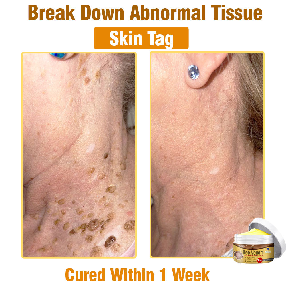 ⛑️🇦🇺 flysmus™ Bee Venom Comprehensive Skin Treatment Cream 🇦🇺 Dermatologist Approved