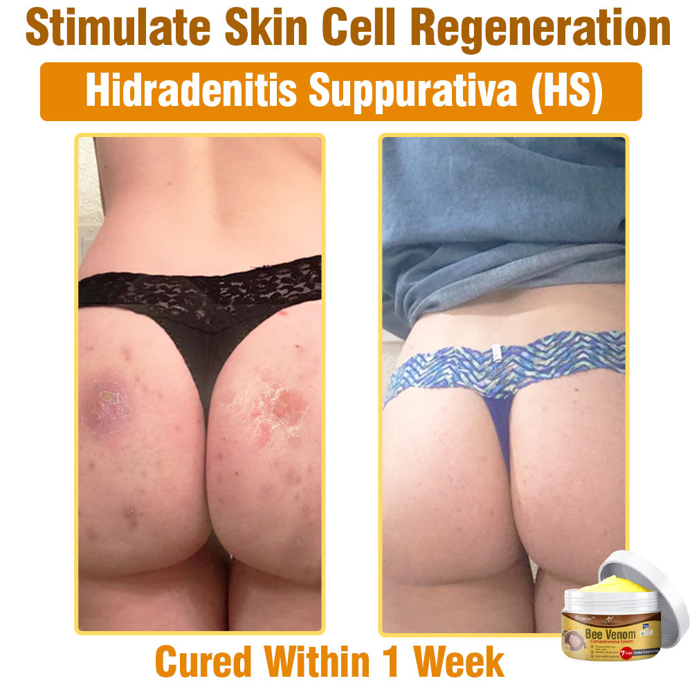 ⛑️🇦🇺 flysmus™ Bee Venom Comprehensive Skin Treatment Cream 🇦🇺 Dermatologist Approved