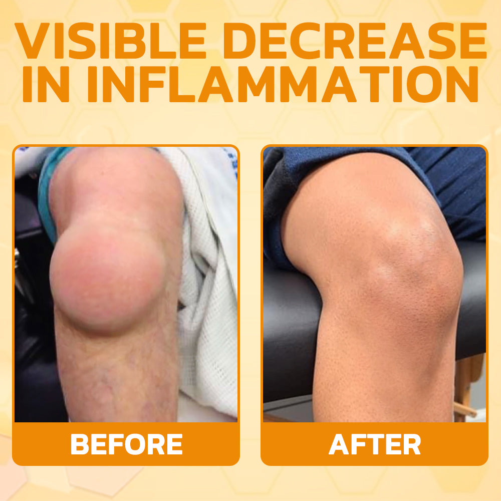 ❤️🔥Aetheris™ Bee Venom Instant Ultra Strength Pain Relief Therapy Cream🇦🇺(ARA Approved)