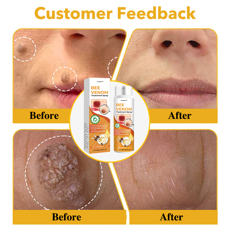 🐝Furzero™ Bee Venom Therapy Spray(✅Dermatest Certification)