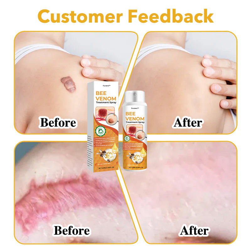 🐝Furzero™ Bee Venom Therapy Spray(✅Dermatest Certification)