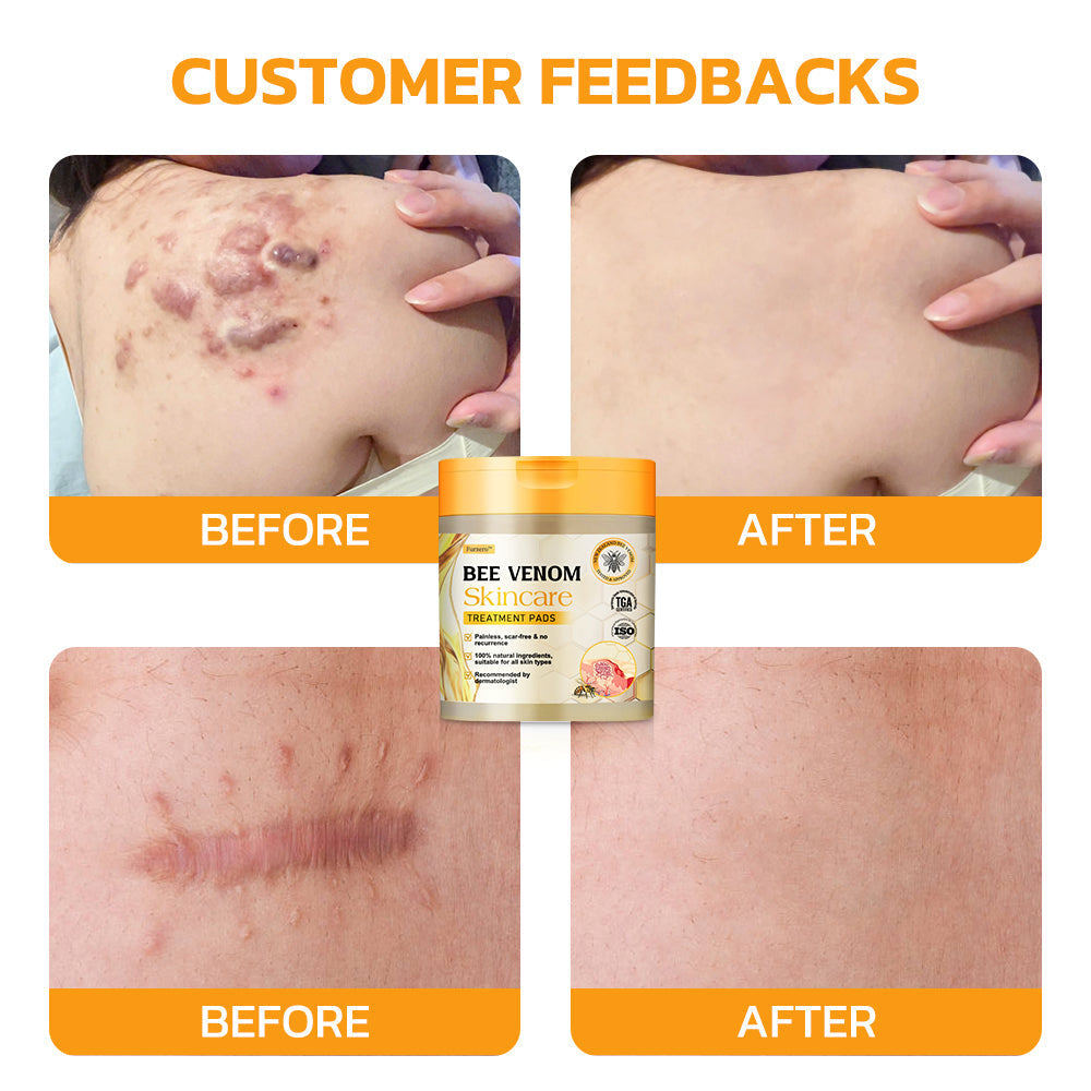 ⭐️Furzero™ Bee Venom Skincare Treatment Pads (👩🏼⚕️AAD Recommended)